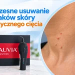 Usuwanie włókniaków plazmą IQ Neauvia w gabinecie dermatologicznym